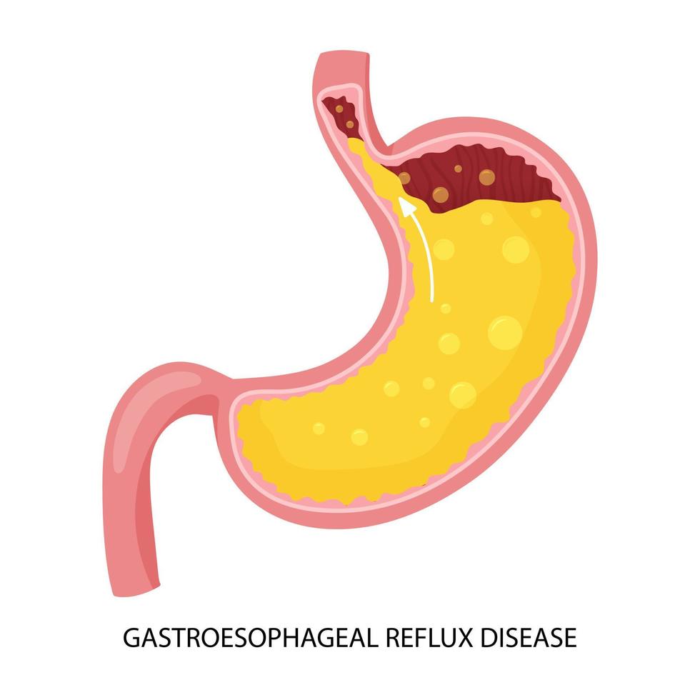 enfermedad por reflujo gastroesofágico e ilustración de acidez estomacal vector