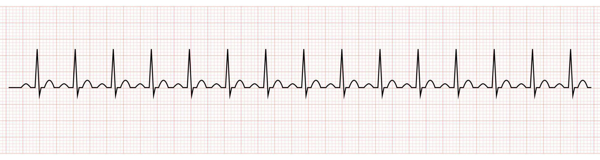 EKG Showing Sinus tachycardia of Patient vector
