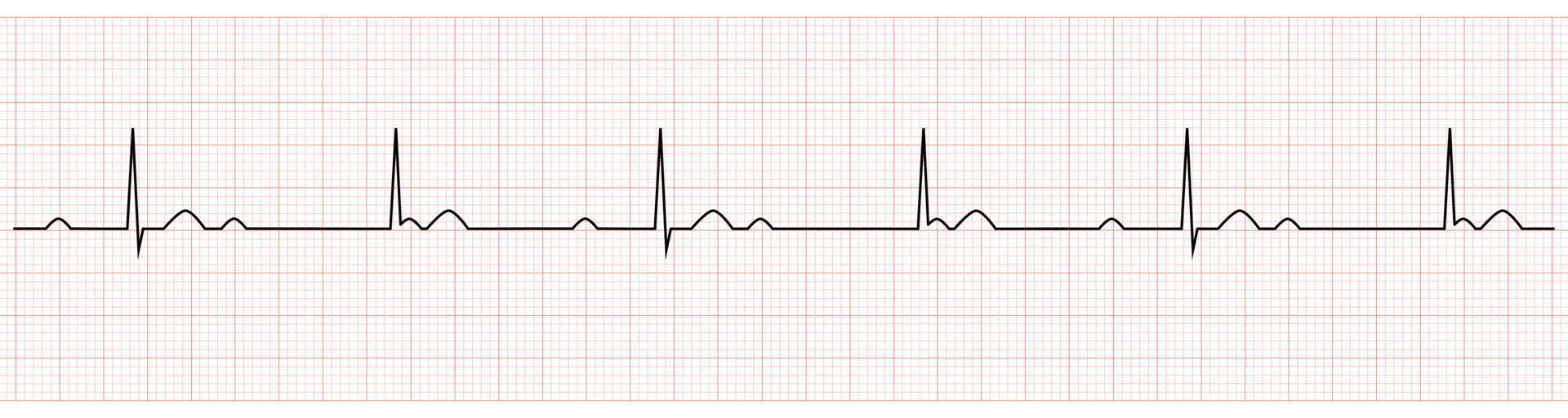 electrocardiograma que muestra bloqueo av completo o de tercer grado vector