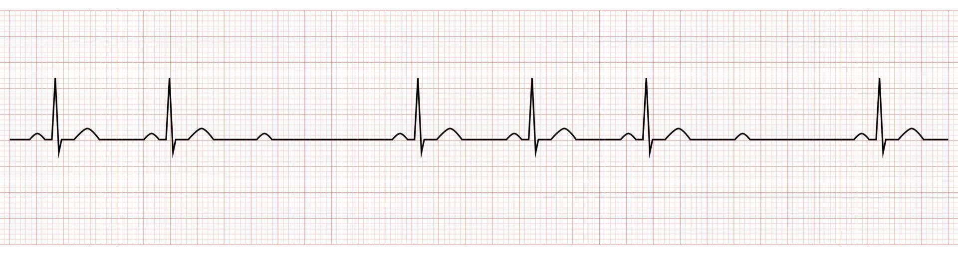 electrocardiograma que muestra bloqueo av de segundo grado mobitz ii vector