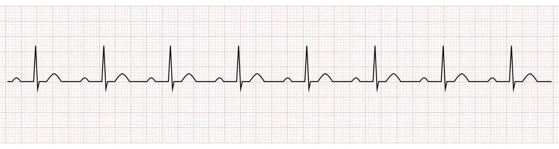 electrocardiograma que muestra prolongación pr, que es signo de bloqueo av de primer grado vector