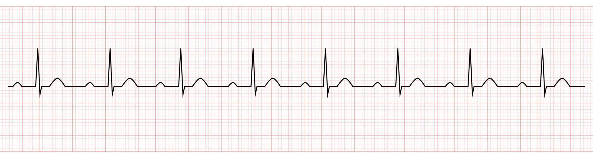 EKG Showing PR prolong which is Sign of First degree AV Block vector