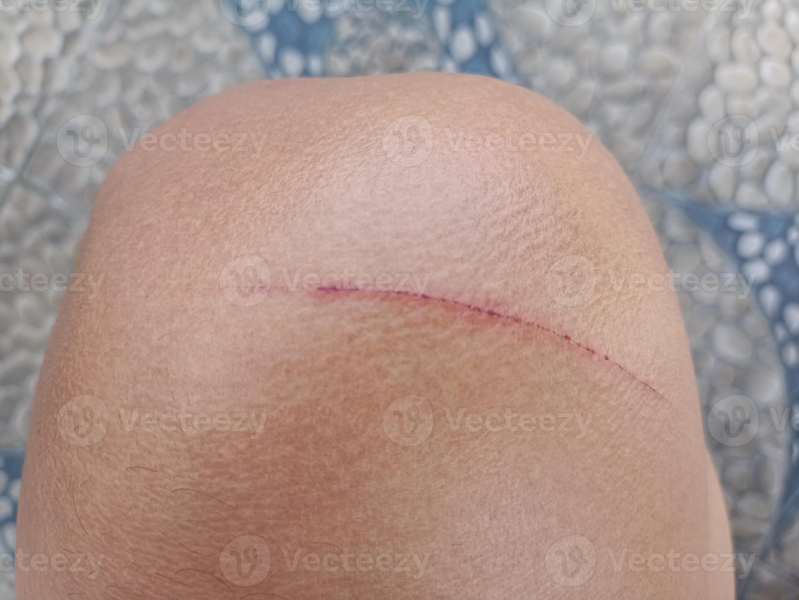 scratched or injured knee. 19077159 Stock Photo at Vecteezy
