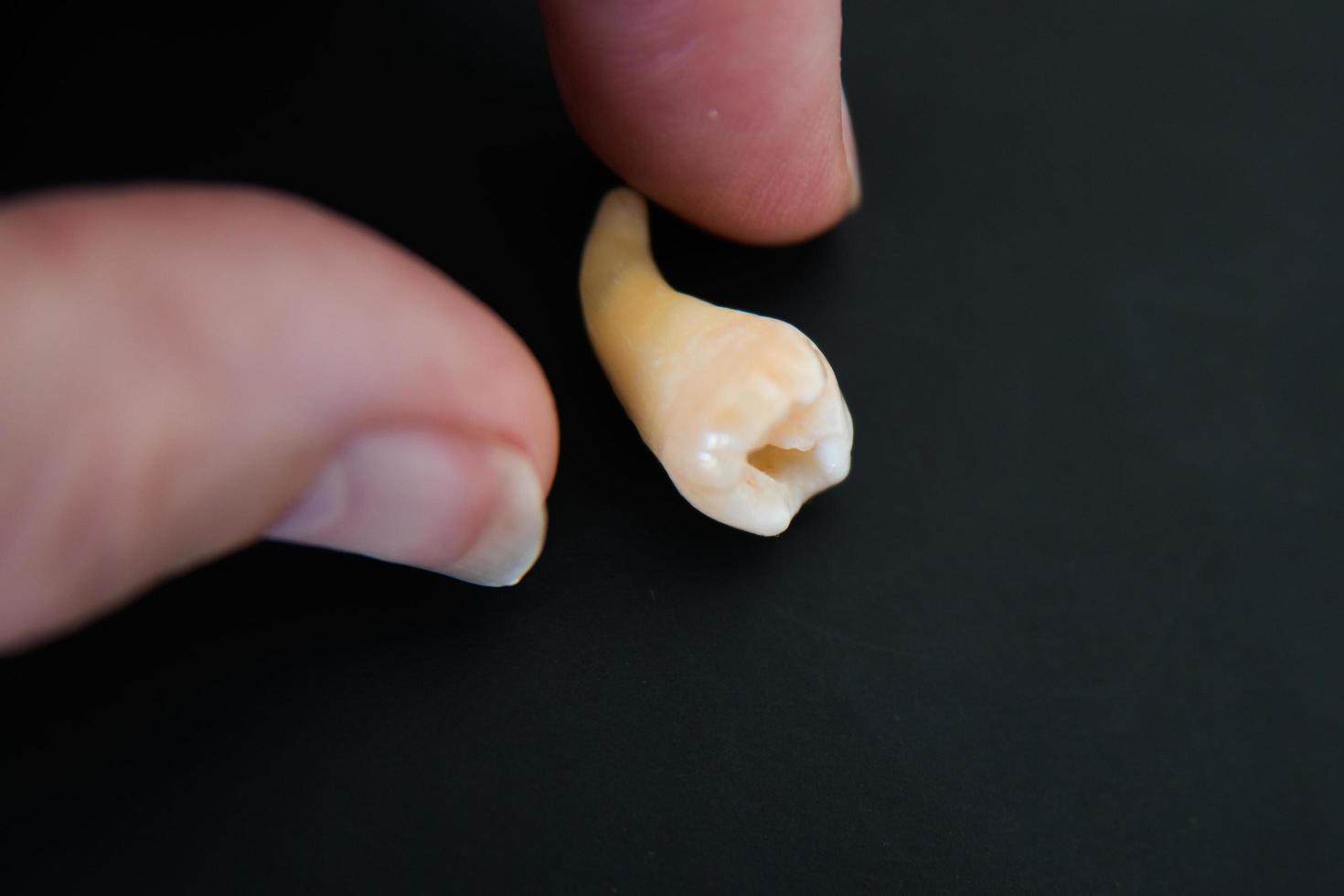 mano humana cerca de un diente de mejilla extraído foto