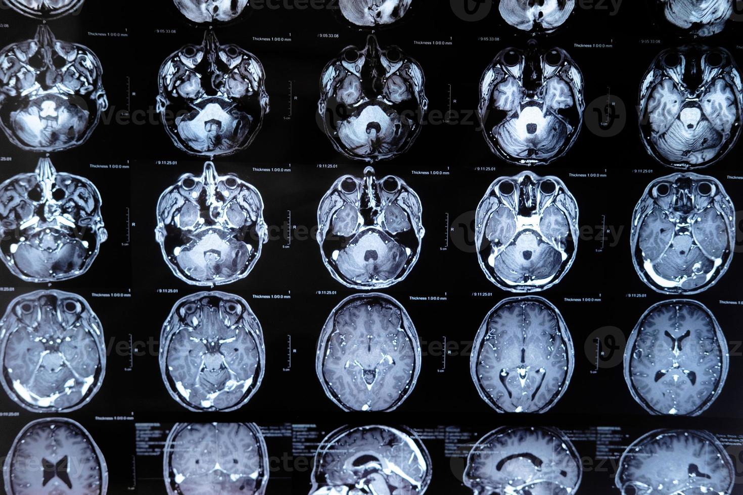 mri con tumor cerebral. imagen de resonancia magnética. foto