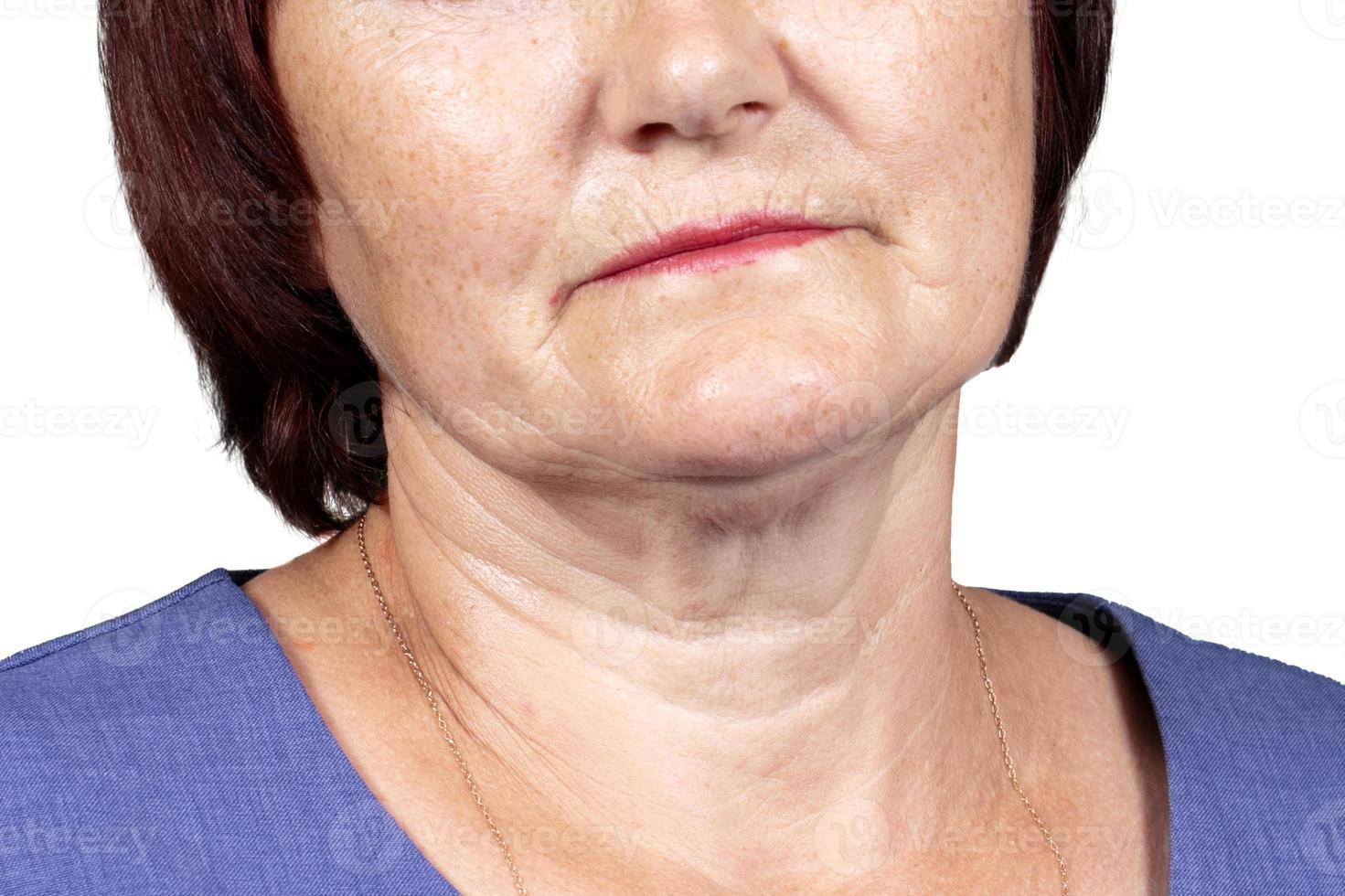 la parte inferior de la cara y el cuello de una anciana con signos de