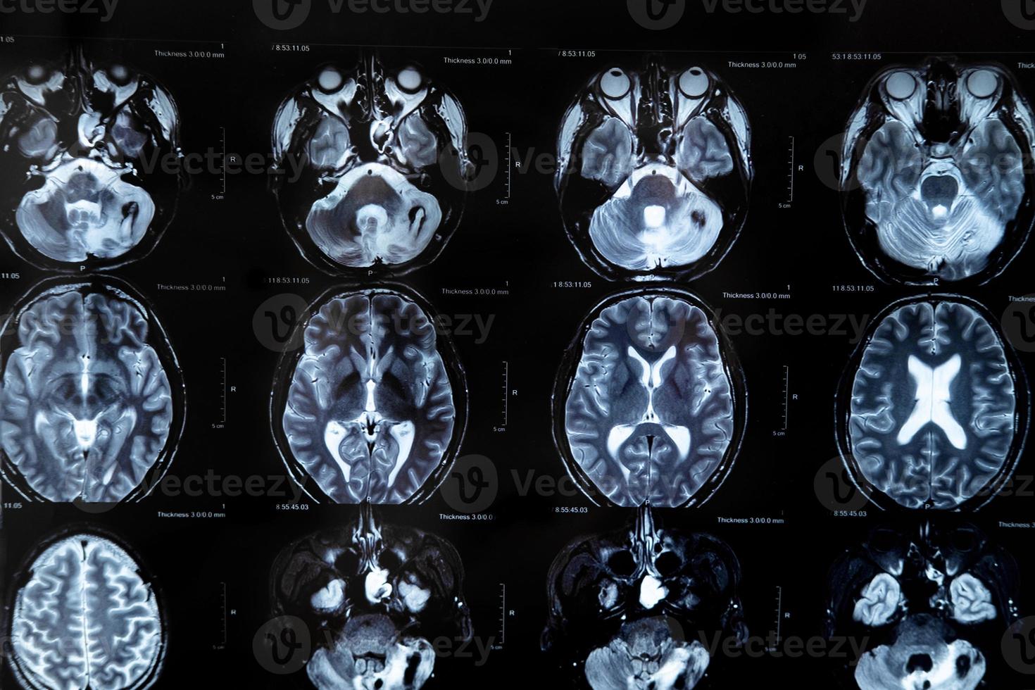 mri with brain tumor. Magnetic resonance imaging. photo