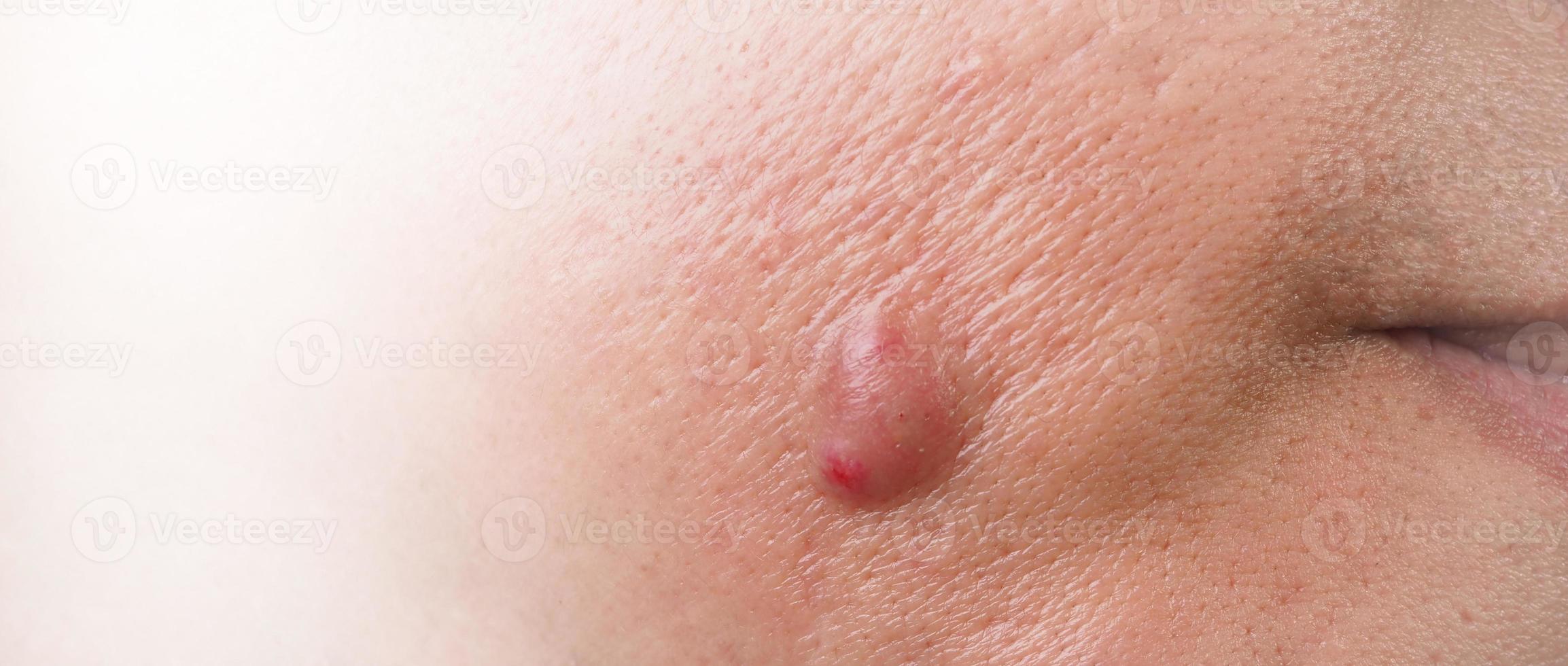 Bacterial skin infection. Big Acne Cyst Abscess or Ulcer Swollen area within face skin tissue. Containing accumulation of pus and blood. Macro shot of Acne or Dermatitis near mouth on face. Skincare. photo