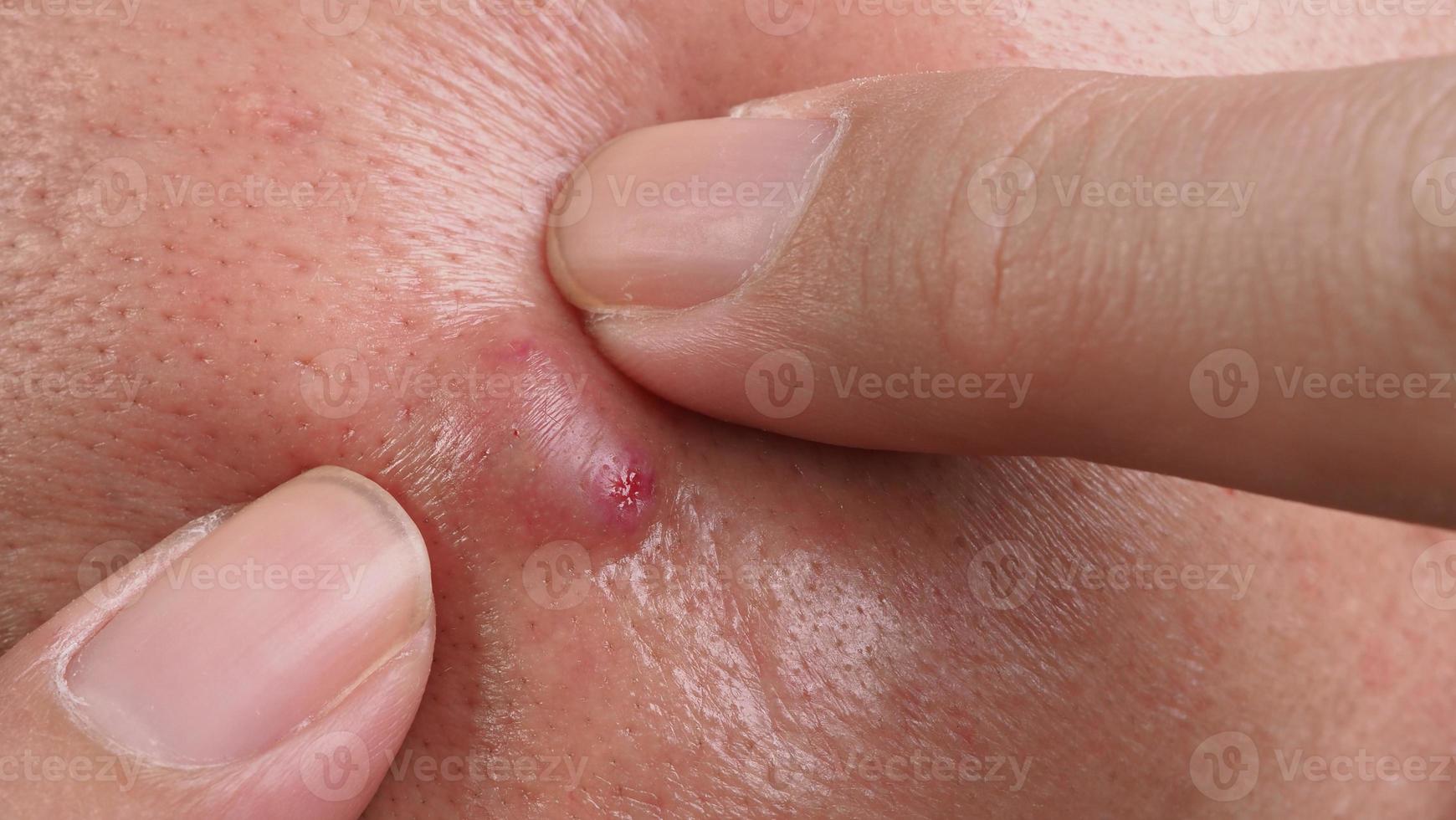 Bacterial skin infection. Big Acne Cyst Abscess or Ulcer Swollen area within face skin tissue. Containing accumulation of pus and blood. Macro shot of Acne or Dermatitis near mouth on face. Skincare. photo