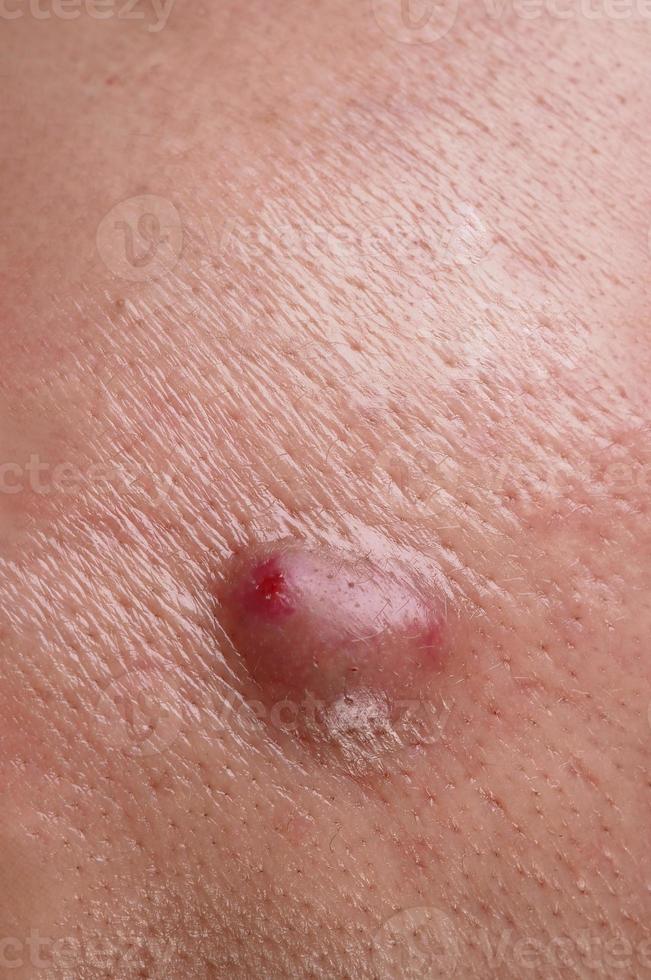 Bacterial skin infection. Big Acne Cyst Abscess or Ulcer Swollen area  within face skin tissue. Containing
