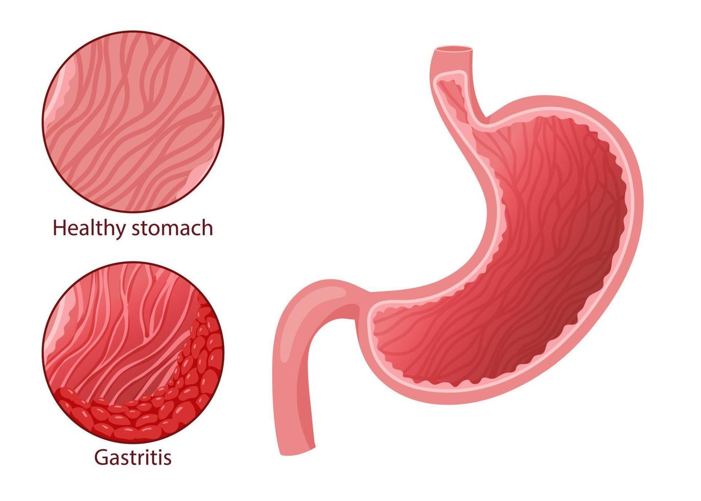 ilustración de estómago saludable y gastritis vector