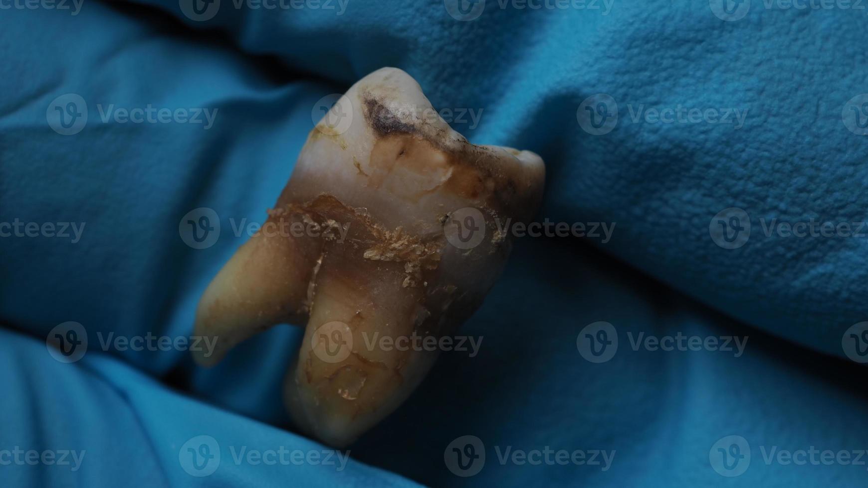 caries dental y mano de dentista con guante y fondo negro. toma macro de dientes cariados hasta la raíz después de la extracción del dentista. anatomía dental real debido a la falta de cuidado dental. vista superior de los dientes de caries foto