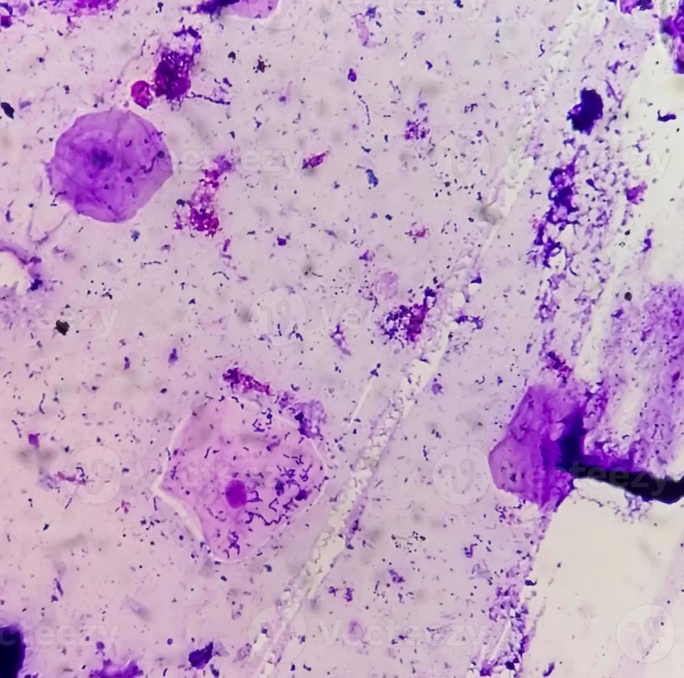 Gram stain of High vaginal swab, photomicrograph. photo