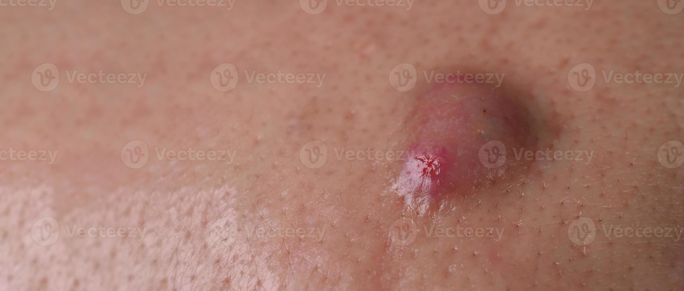 Absceso de quiste de acné grande o área inflamada de úlcera dentro del tejido de la piel de la cara. foto