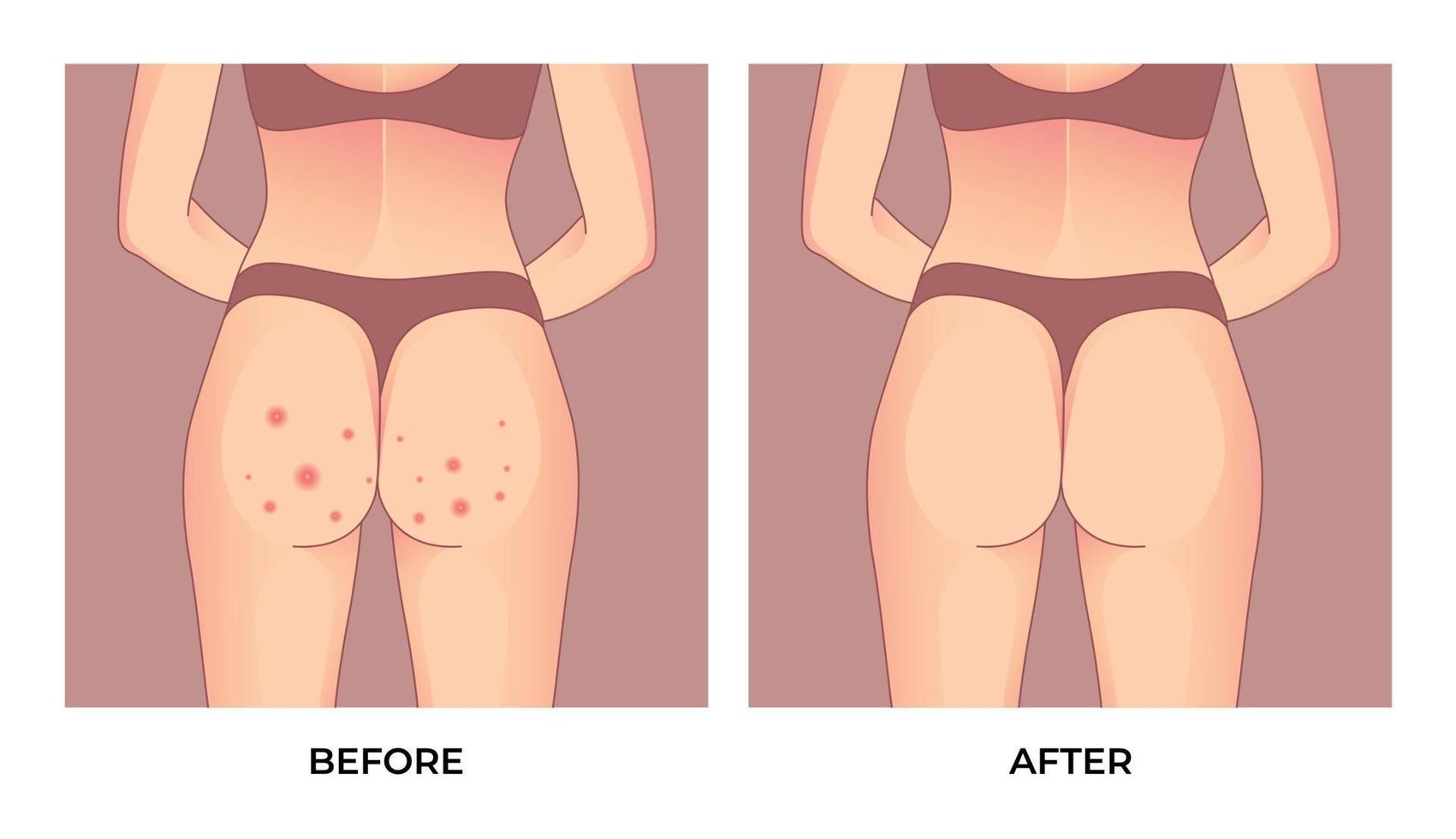 Buttocks with red pimples, Before and after skin treatment. vector