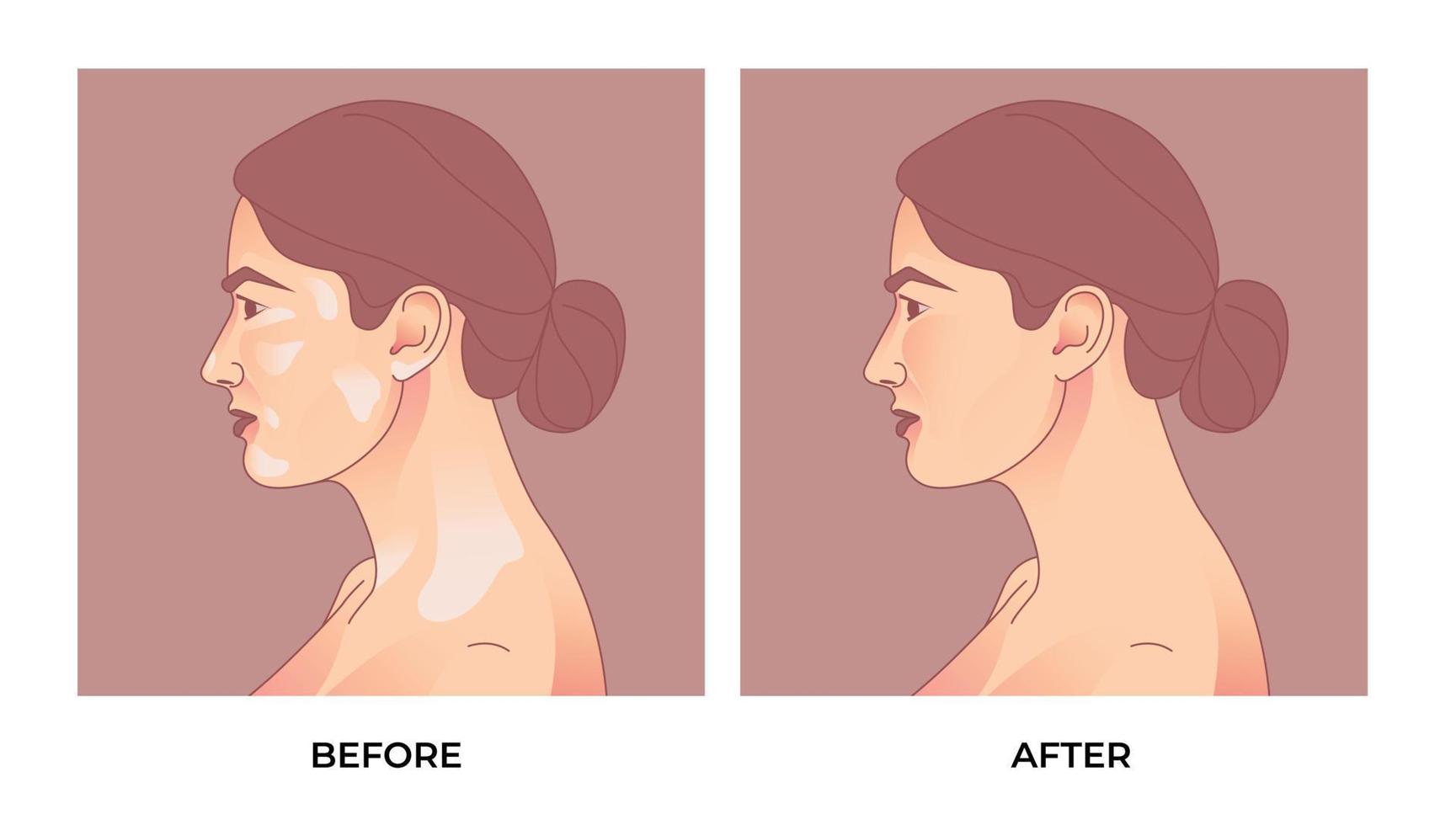 comparación de rostro de mujer con y sin vitíligo. antes y después del tratamiento de pigmentación de la piel con vitíligo vector