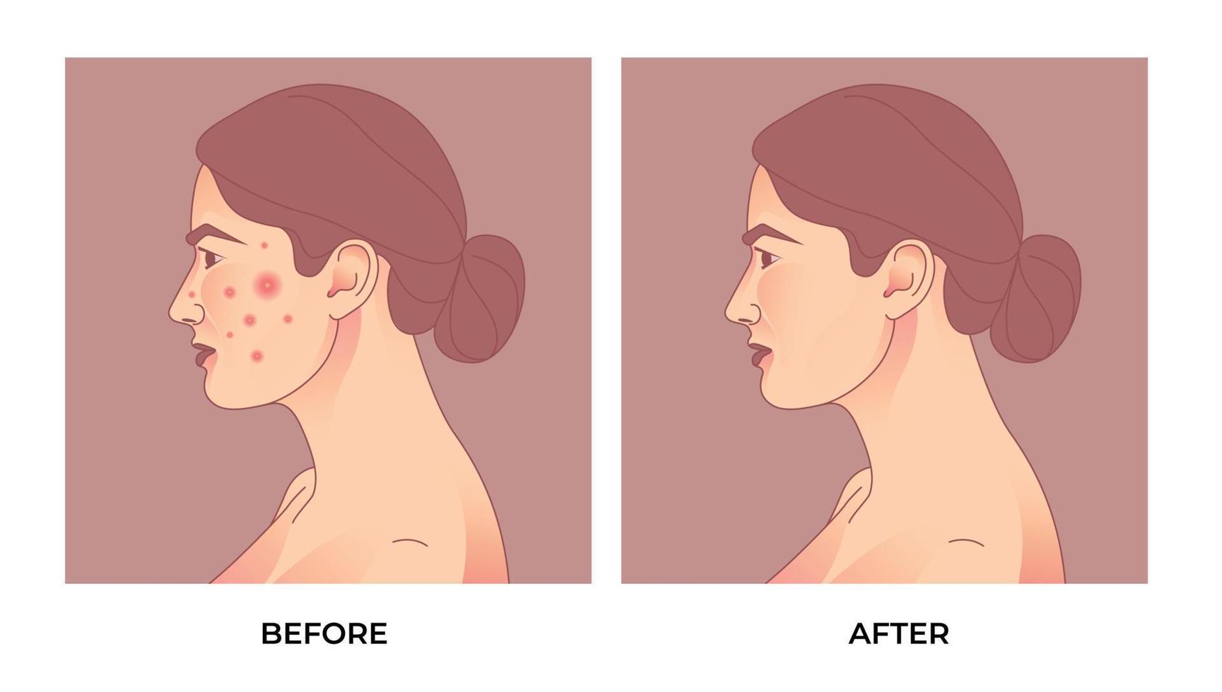 las mujeres se enfrentan con piel problemática. Tratamiento del acné antes y después. concepto de cuidado de la piel. vector