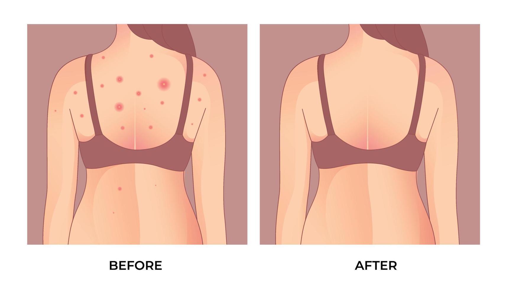 chica con acné, con manchas rojas en la espalda, foliculitis inflamatoria, tratamiento del acné antes y después. concepto de cuidado de la piel. vector