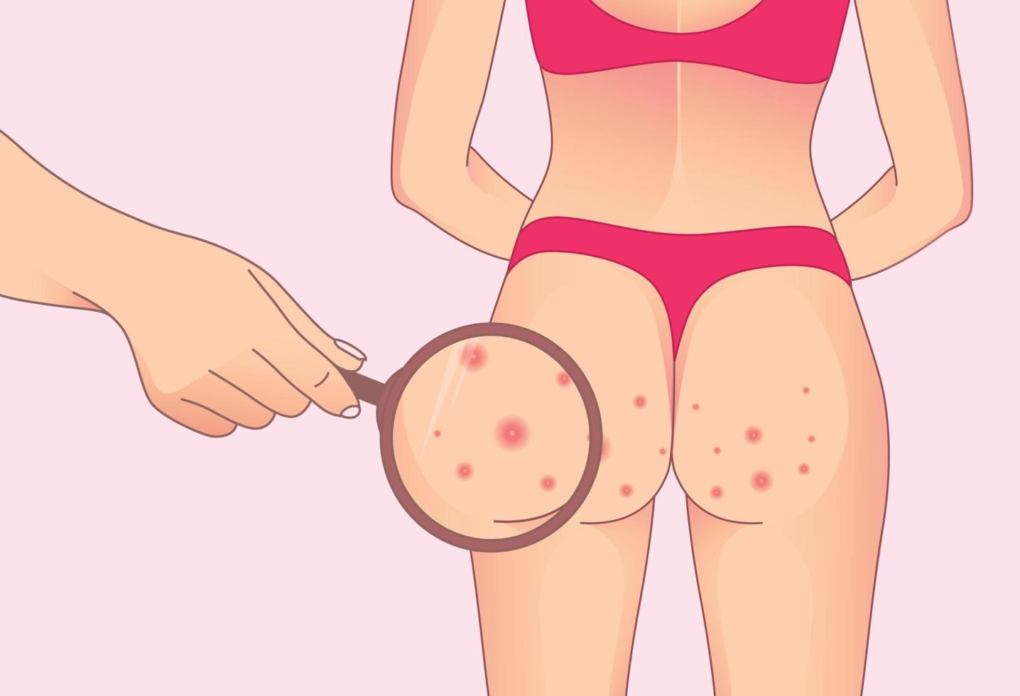 WebButtocks with red pimples. skin bubble rash vector