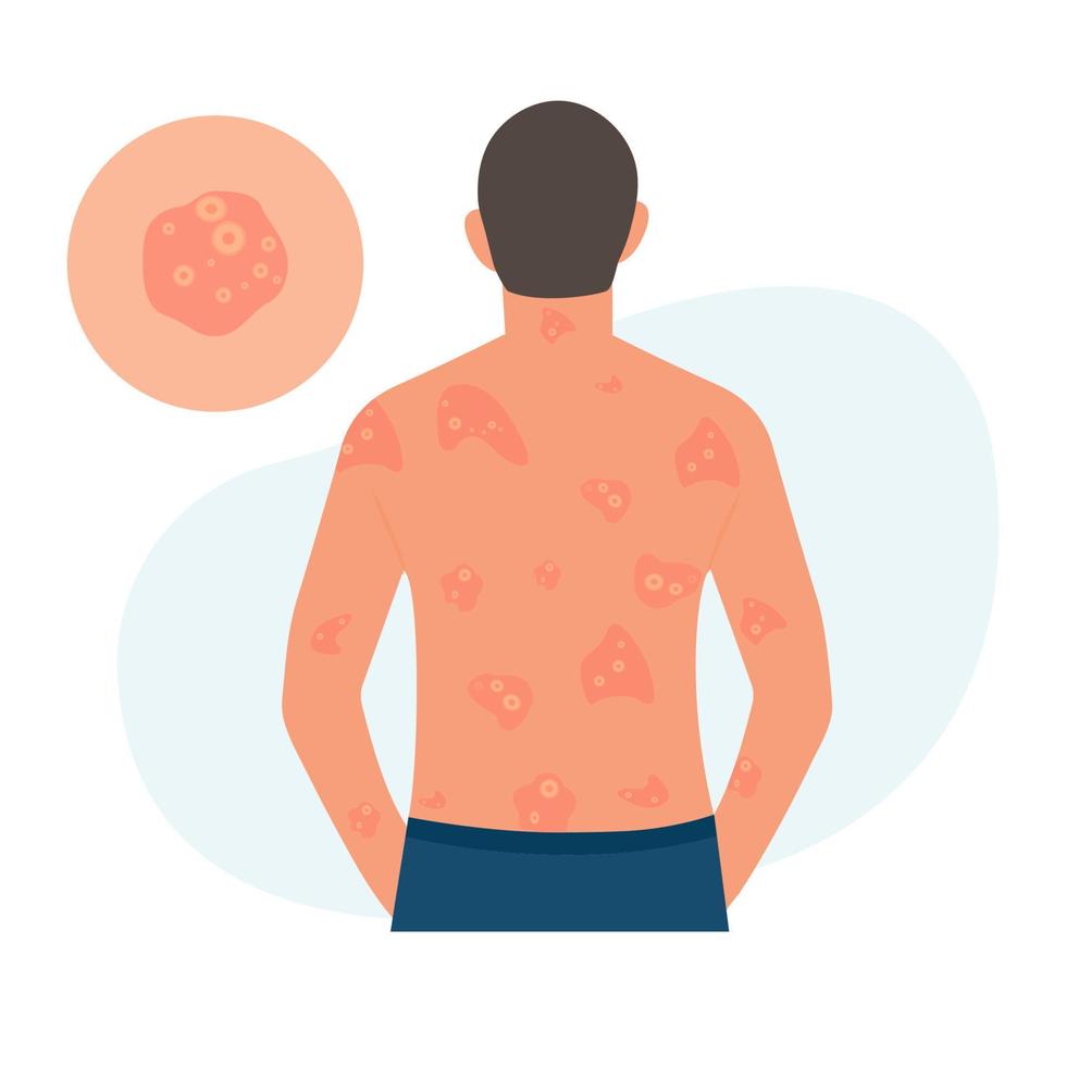 The man has alergic itching, skin inflammation, redness and irritation. Pustular psoriasis.Atopic dermatitis, eczema, psoriasis, dry skin. Skin problems Concept, isolated, vector. vector