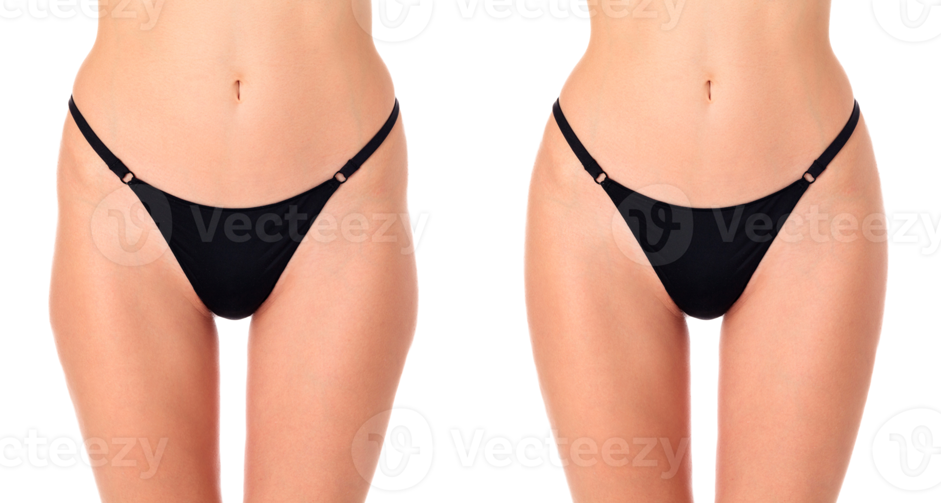 Closeup shot of female thighs before and after treatment, isolated png