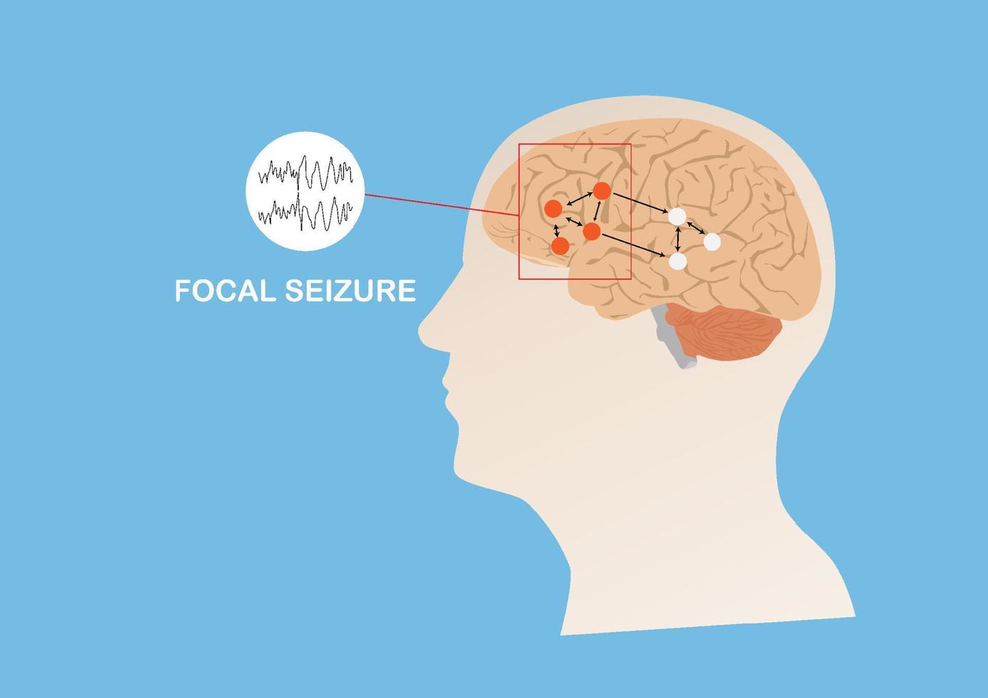 Illustration of abnormal electrical activity causing focal seizure. vector