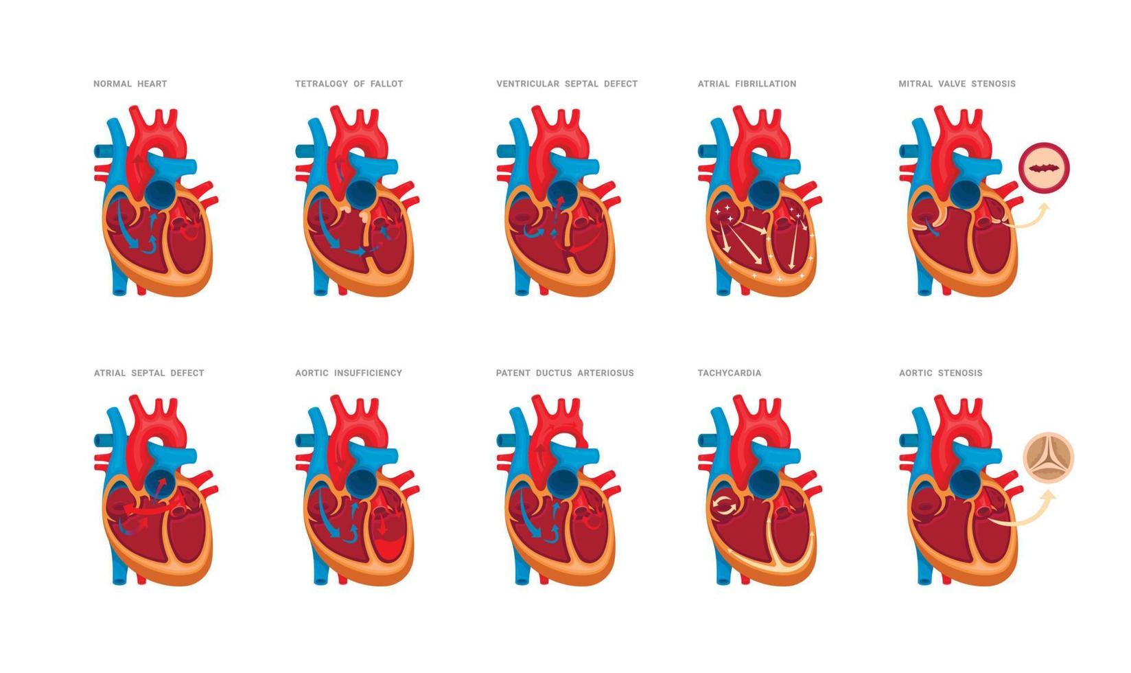 conjunto de corazón defectos vector