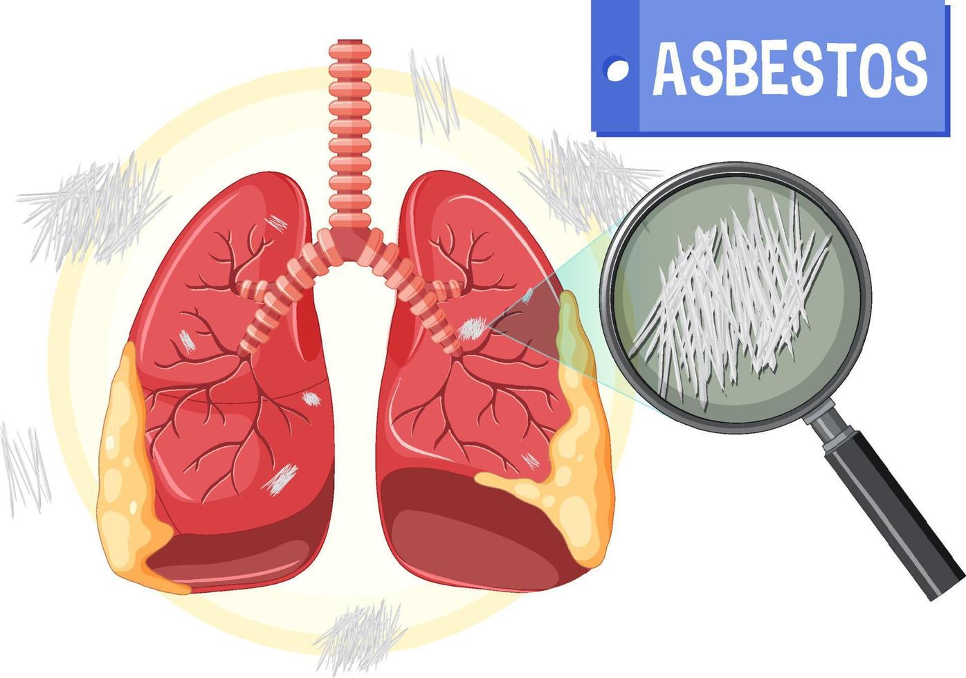 diagrama que muestra la asbestosis en los pulmones vector