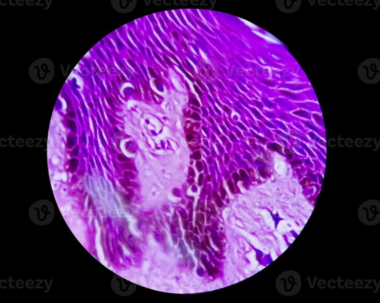 Histological biopsy of Scrotal wall under microscopy showing Calcinosis cutis. Scrotal calcinosis. Calcinosis cutis of scrotum photo
