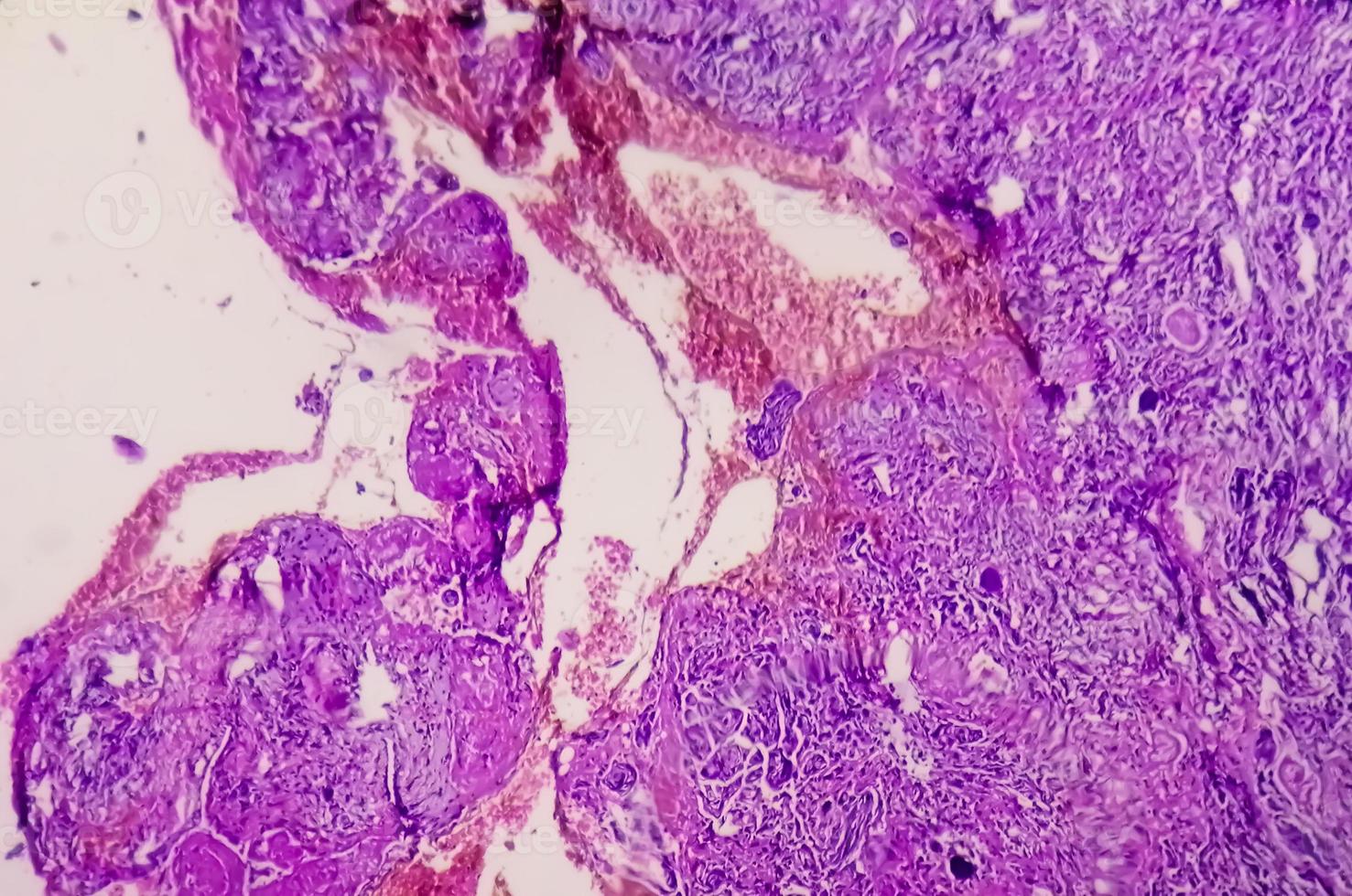 Spinal tumor biopsy showing Psammomatous meningioma. Psammoma bodies. photo