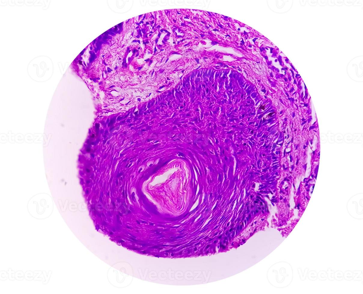 Skin biopsy, Suggestive of Basal cell carcinoma, the most common type of skin cancer. photo