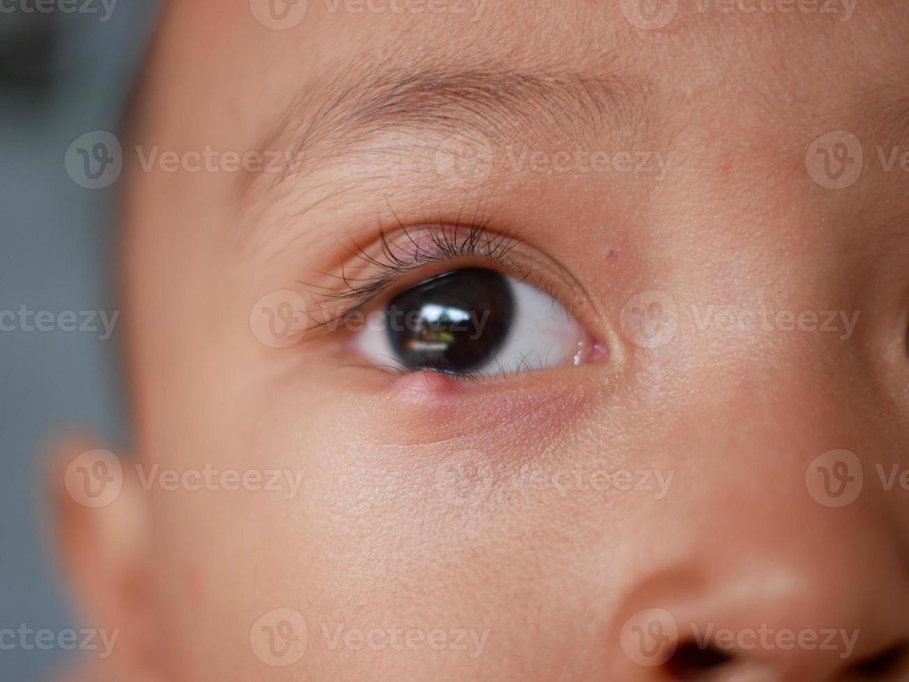 Closeup of Infected child eye patch with painful bump on lower eyelid. eye disease photo