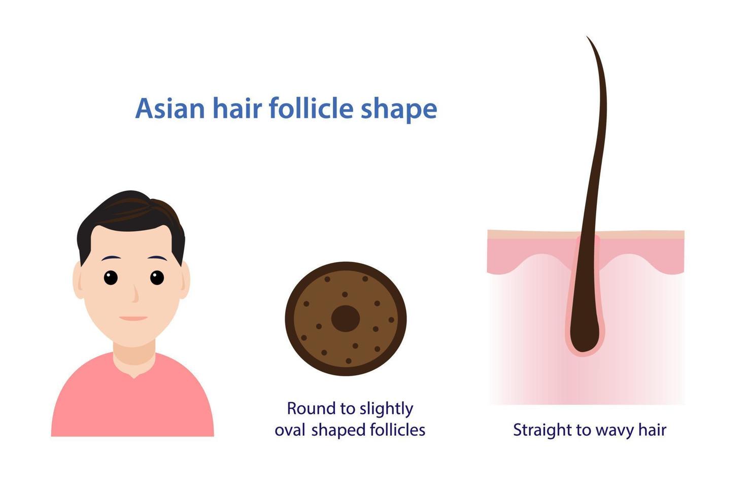 Infographic of Asian hair follicle shape vector illustration isolated on white background.