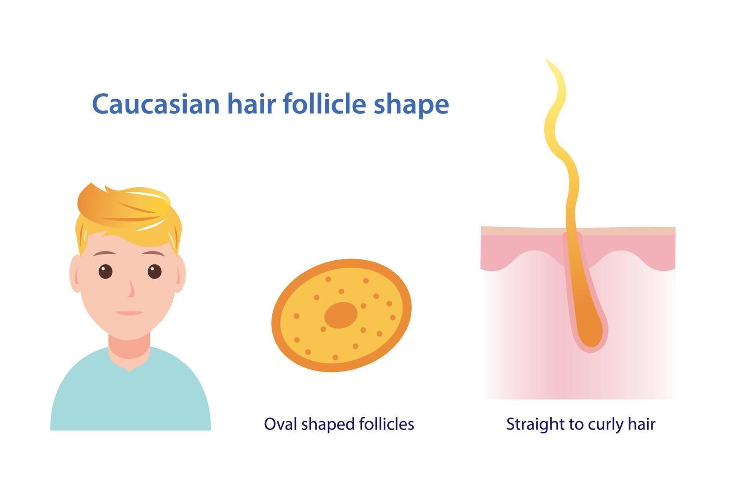 Infographic of Caucasian hair follicle shape vector illustration isolated on white background.