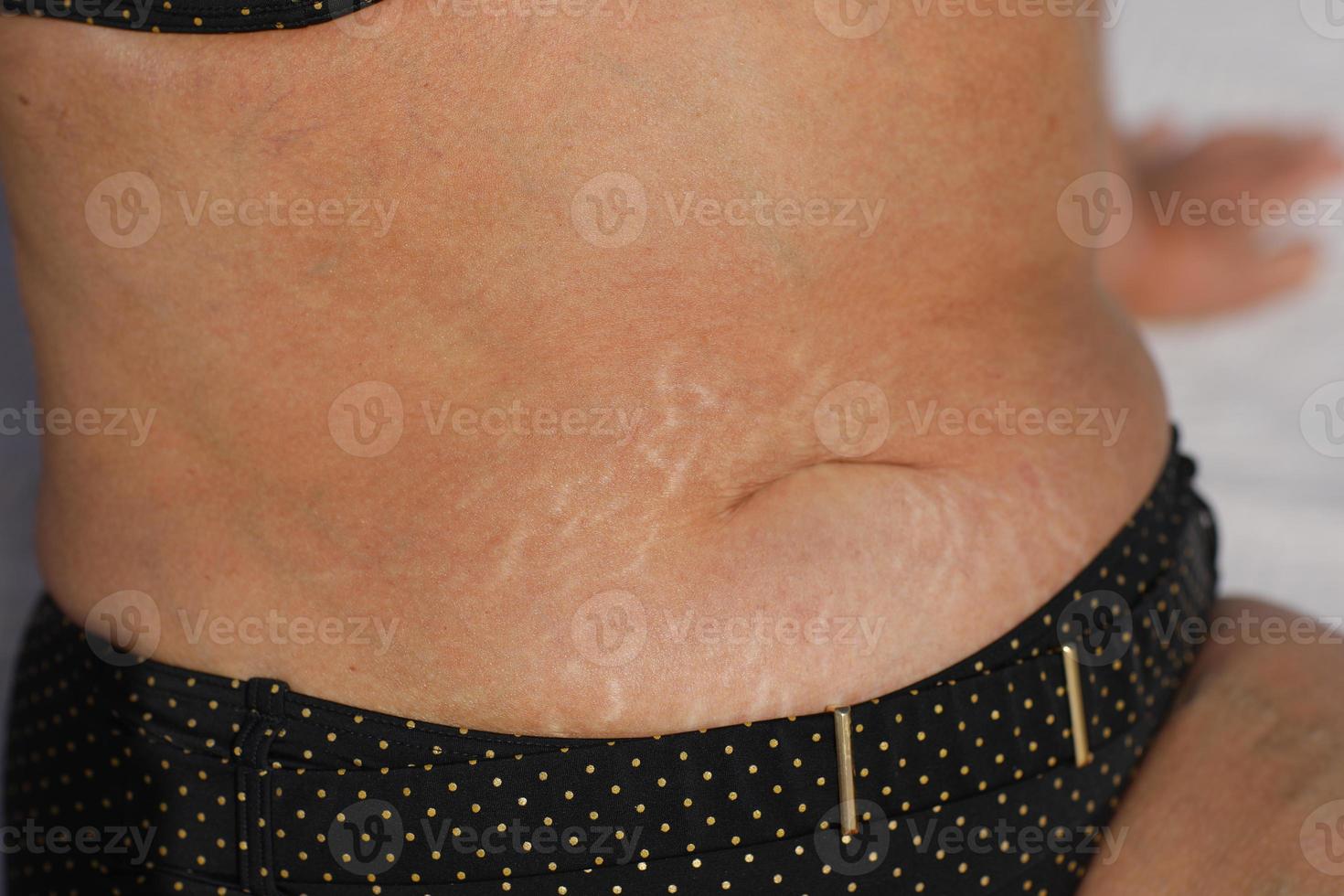 Woman with fat abdomen, overweight female stomach, stretch marks on belly closeup. High quality photo