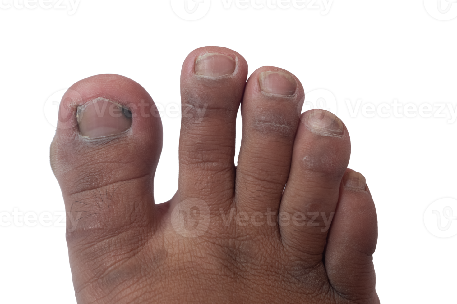 dirty and moldy human toenail, medical and healthcare concept png