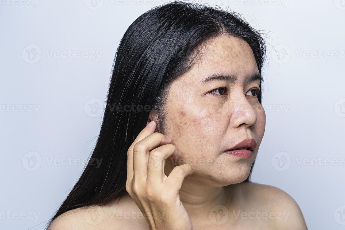 Asian adult woman face has freckles, large pores, blackhead pimple and scars problem from not take care for a long time. Skin problem face isolated white background. Treatment and Skincare concept photo