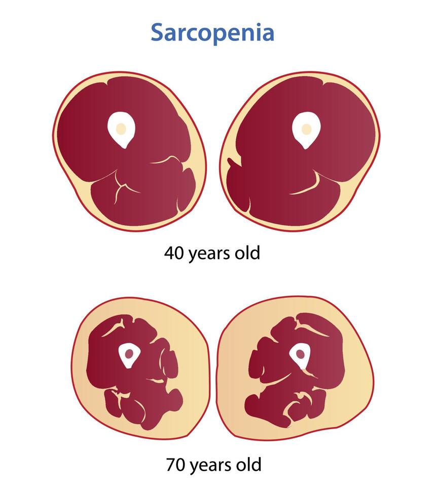 Sarcopenia vector illustration isolated on white background.