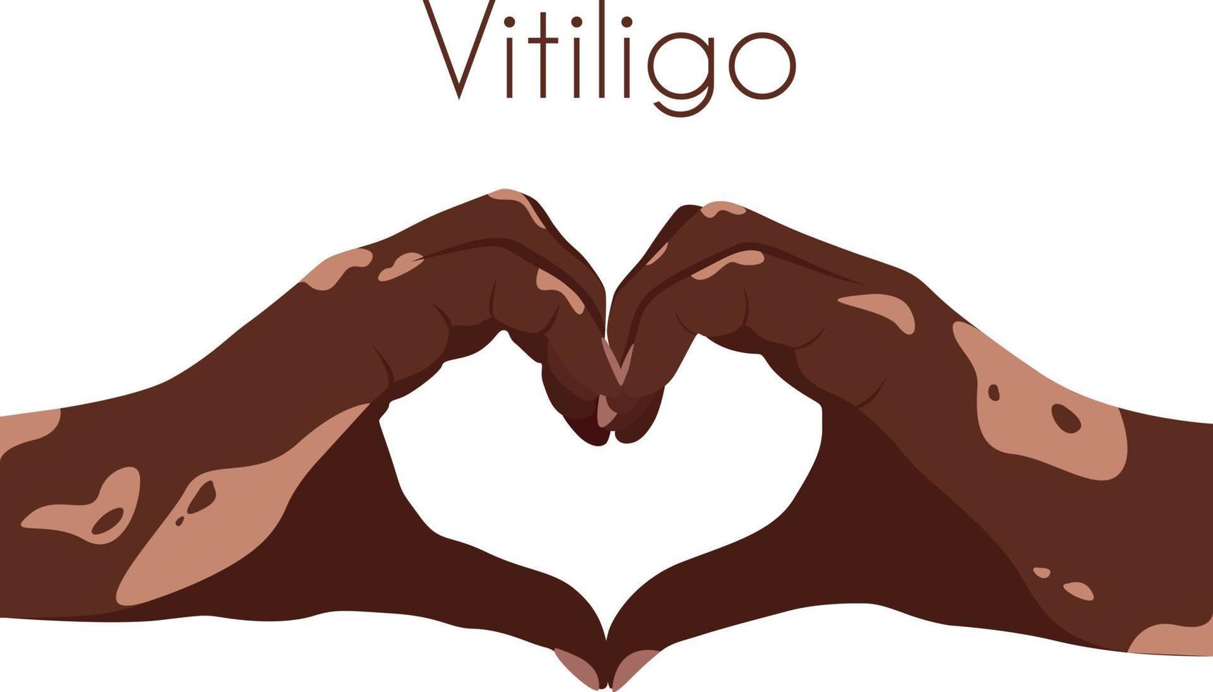 Two hands with vitiligo patches in the shape of a heart. Self love concept. World Vitiligo Day. I love my skin. Brown skin with a patch of vitiligo. Skin diseases. Self care vector