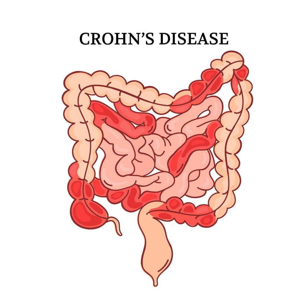 CROHN DISEASE Intestines Medicine Anatomy Vector Illustration