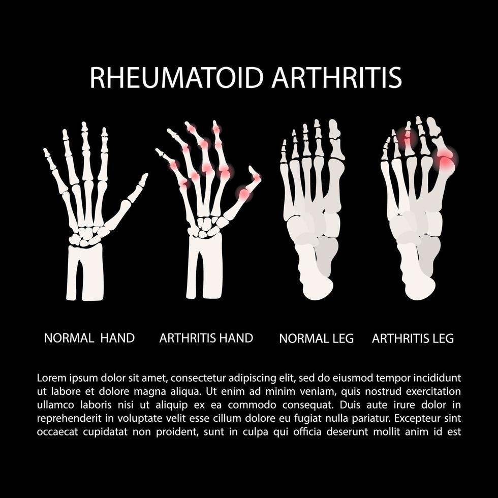 artritis mano pierna reumatoide medicina educación vector esquema