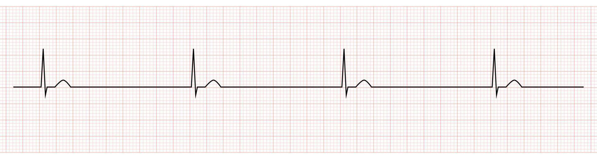 ekg monitor demostración unión bradicardia vector