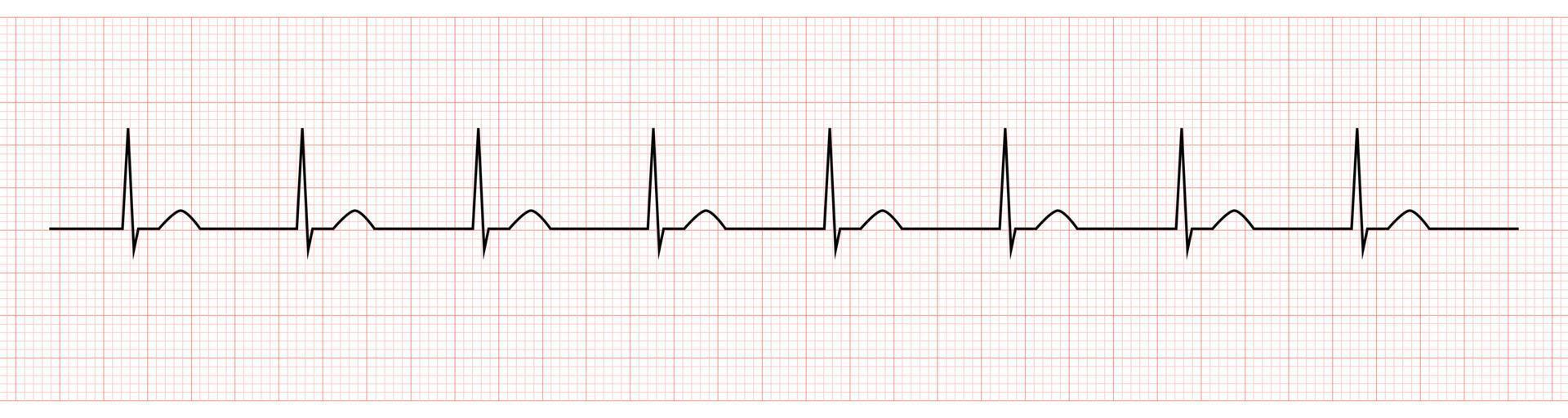 EKG Monitor Showing accelerated junctional rhythm vector