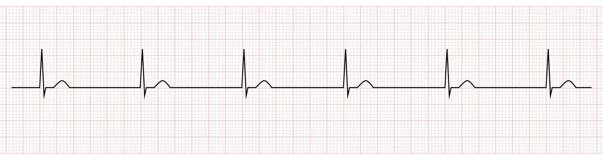 EKG Monitor Showing junctional escape rhythm vector