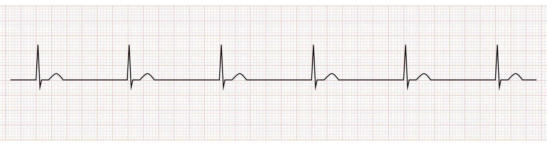 EKG Monitor Showing junctional escape rhythm vector