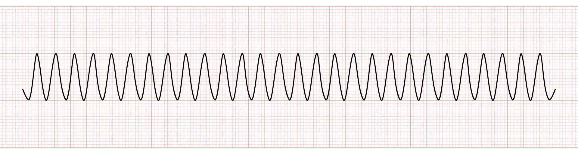 EKG Monitor Showing Ventricular tachycardia or VT vector