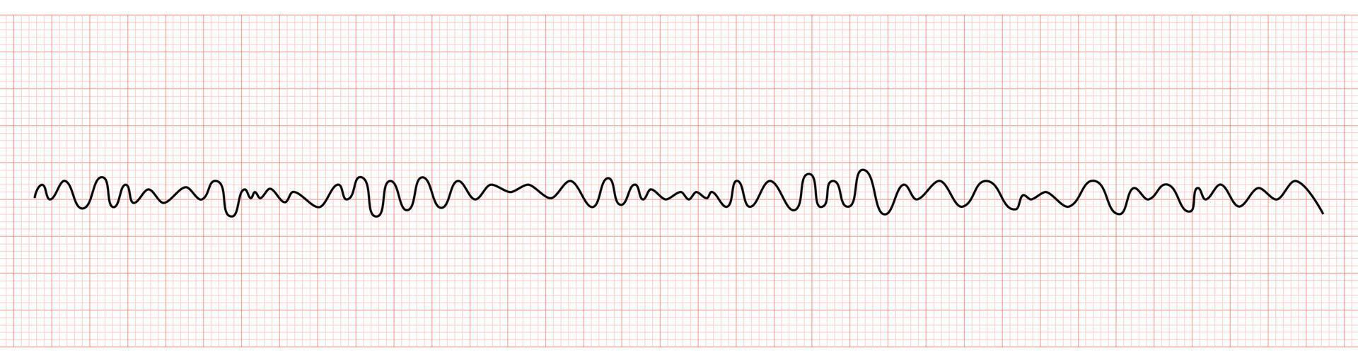 EKG Monitor Showing Ventricular Fibrillation or VF vector