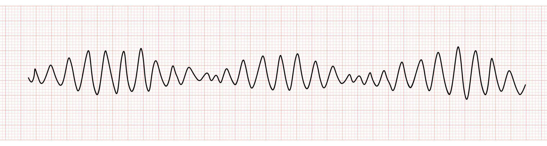 EKG Monitor Showing Polymorphic Ventricular tachycardia or VT Torsades de pointes vector