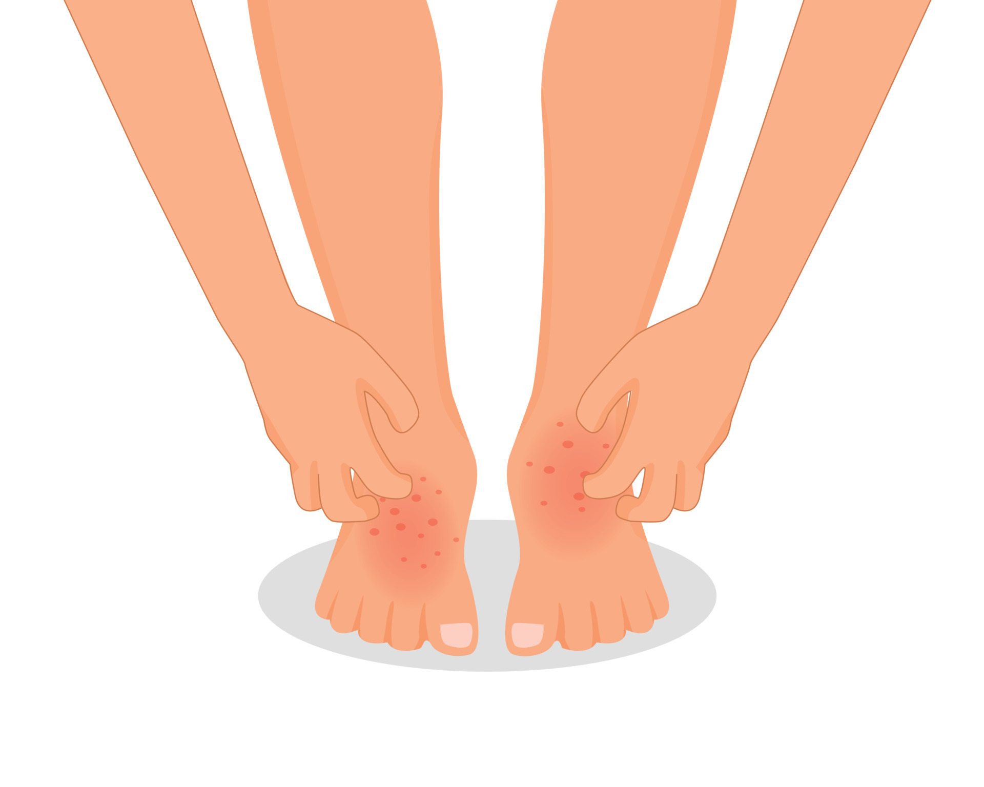 Man hand scratching his itchy feet with rash dry skin because of