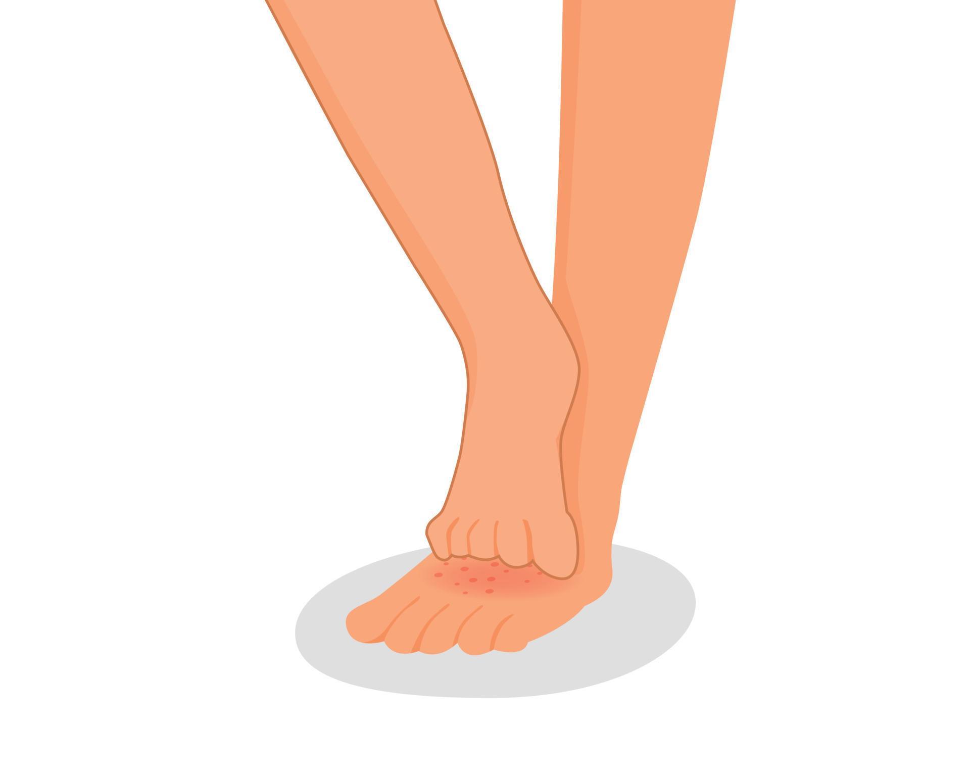 Spiritual Meaning Of Itchy Feet - 0z917xa